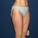 Liposuction Before & After Patient #3656