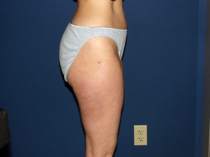 Liposuction Before & After Patient #3656