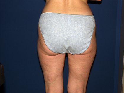 Liposuction Before & After Patient #3656