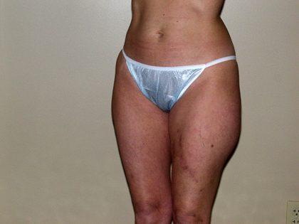 Liposuction Before & After Patient #3656