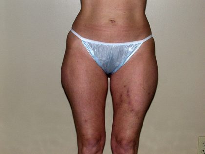 Liposuction Before & After Patient #3656