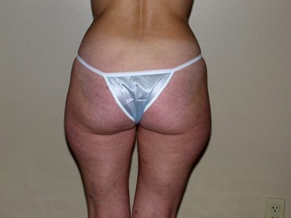 Liposuction Before & After Patient #3656