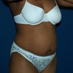 Tummy Tuck Before & After Patient #2037