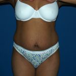 Tummy Tuck Before & After Patient #2037