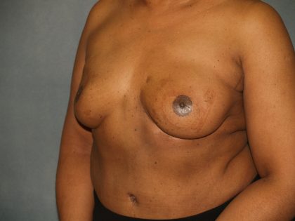 Breast Reconstruction Before & After Patient #1774