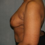 Breast Reconstruction Before & After Patient #1774