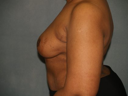 Breast Reconstruction Before & After Patient #1774