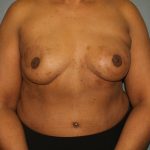 Breast Reconstruction Before & After Patient #1774