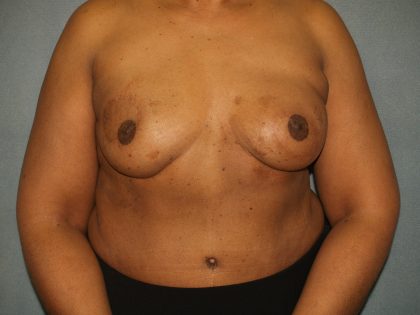 Breast Reconstruction Before & After Patient #1774