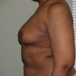 Breast Reconstruction Before & After Patient #1774