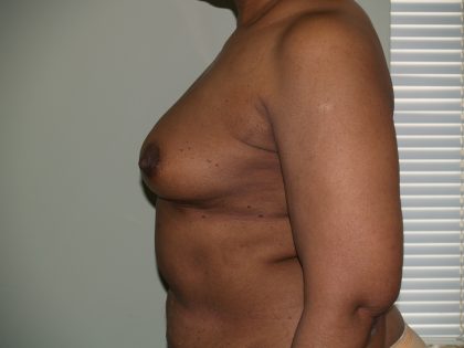 Breast Reconstruction Before & After Patient #1774