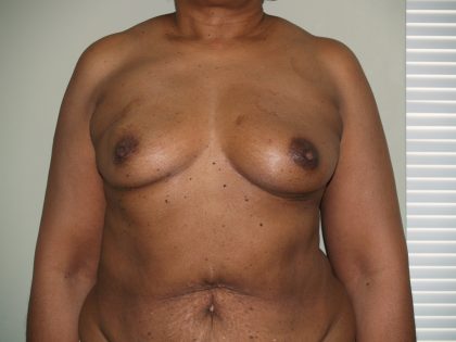 Breast Reconstruction Before & After Patient #1774