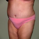 Tummy Tuck Before & After Patient #1976