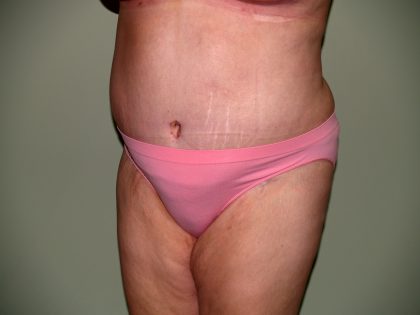 Tummy Tuck Before & After Patient #1976