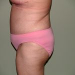 Tummy Tuck Before & After Patient #1976