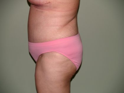 Tummy Tuck Before & After Patient #1976