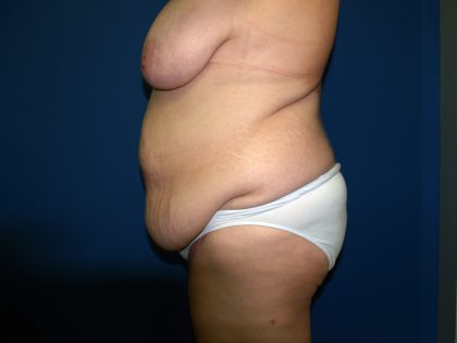 Tummy Tuck Before & After Patient #1976