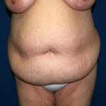 Tummy Tuck Before & After Patient #1976