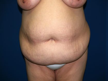 Tummy Tuck Before & After Patient #1976