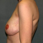 Breast Reconstruction Before & After Patient #1775