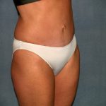 Tummy Tuck Before & After Patient #2295