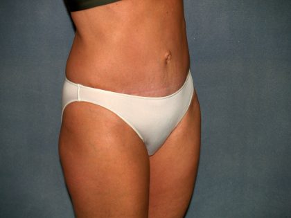 Tummy Tuck Before & After Patient #2295