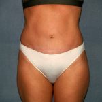 Tummy Tuck Before & After Patient #2295