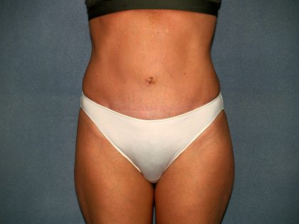 Tummy Tuck Before & After Patient #2295