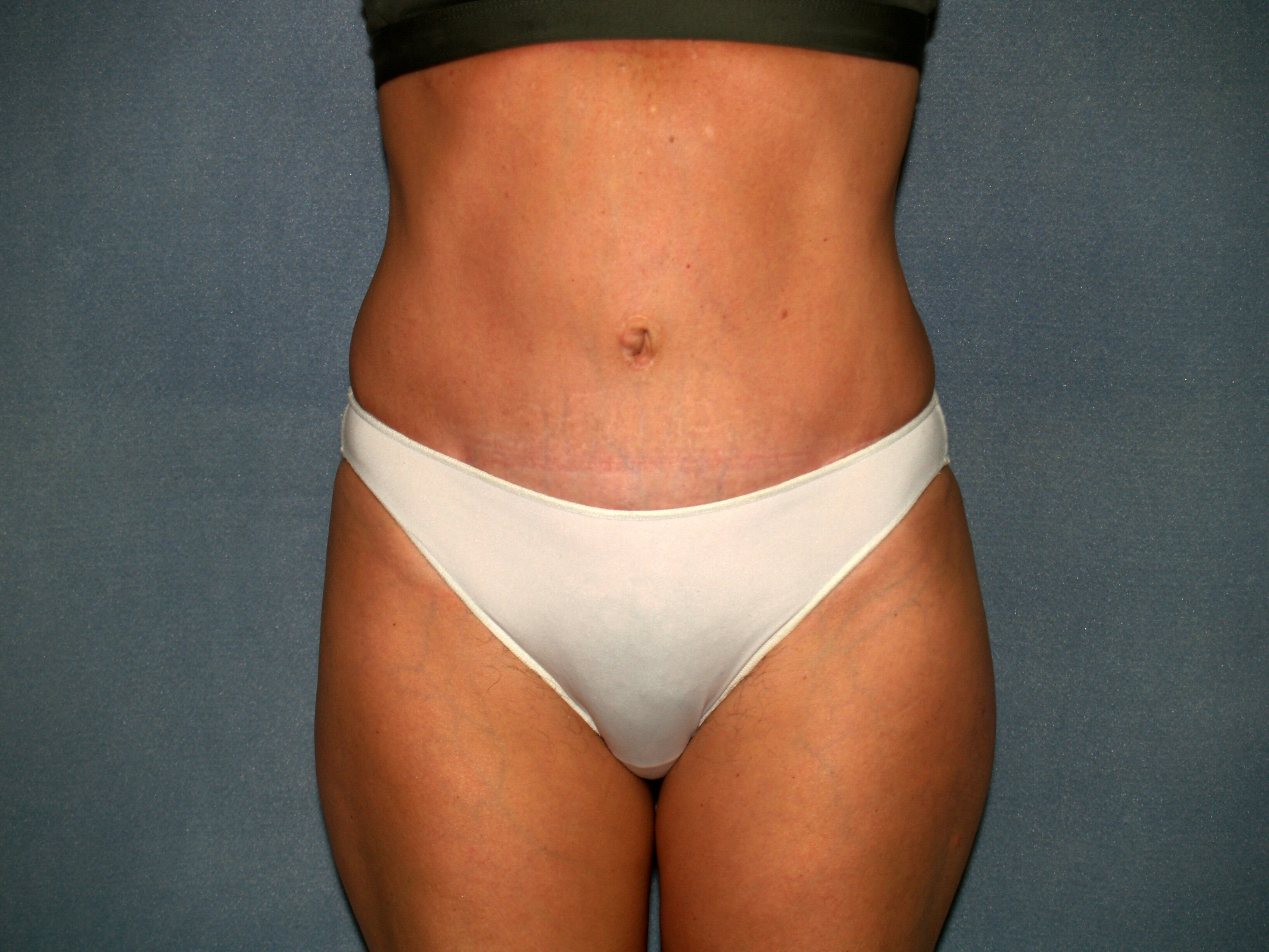Tummy Tuck Before & After Patient #2295