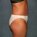 Tummy Tuck Before & After Patient #2295