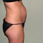 Tummy Tuck Before & After Patient #2295