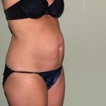 Tummy Tuck Before & After Patient #2295