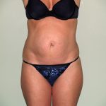 Tummy Tuck Before & After Patient #2295