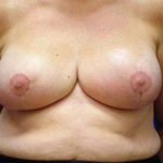 Breast Reduction Before & After Patient #3517