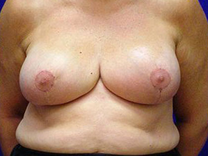 Breast Reduction Before & After Patient #3517