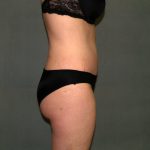 Tummy Tuck Before & After Patient #2261