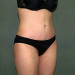 Tummy Tuck Before & After Patient #2261