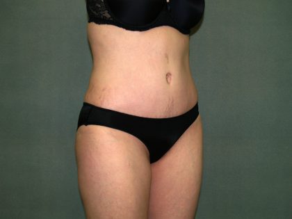 Tummy Tuck Before & After Patient #2261