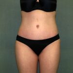 Tummy Tuck Before & After Patient #2261