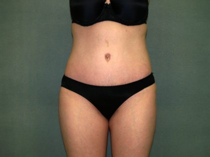 Tummy Tuck Before & After Patient #2261