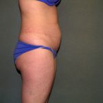 Tummy Tuck Before & After Patient #2261