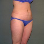Tummy Tuck Before & After Patient #2261