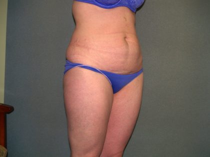 Tummy Tuck Before & After Patient #2261