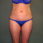 Tummy Tuck Before & After Patient #2261