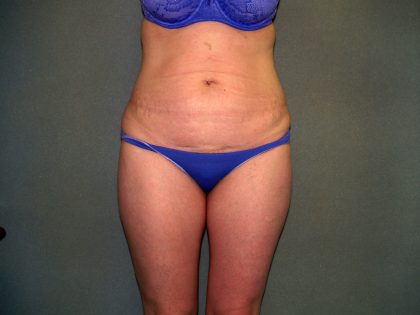 Tummy Tuck Before & After Patient #2261