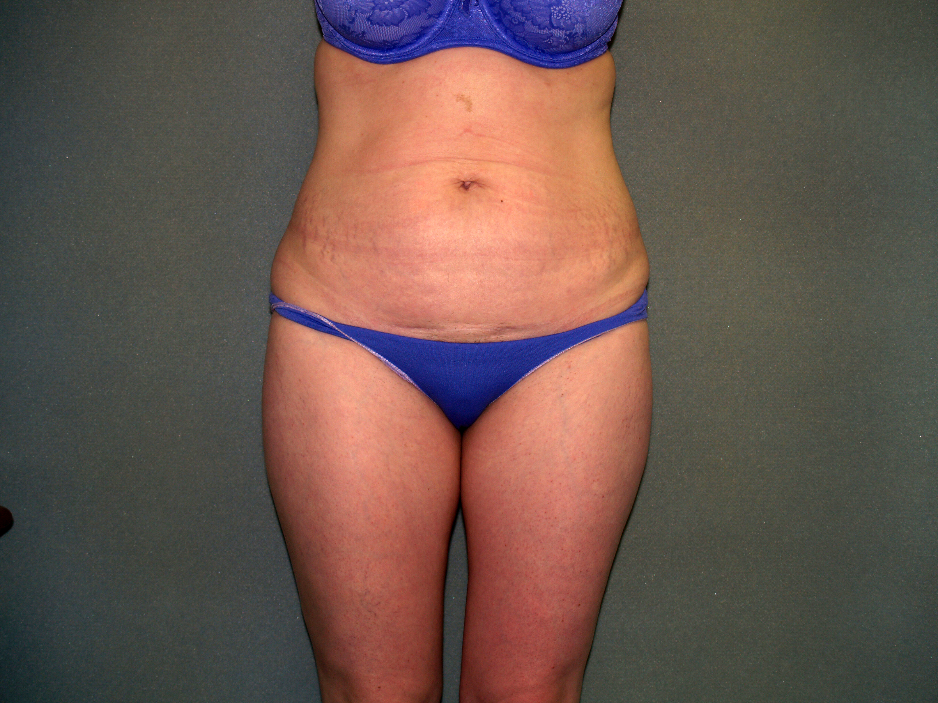 Tummy Tuck Before & After Patient #2261