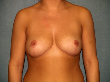 Breast Reduction Before & After Patient #3129