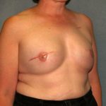 Breast Reconstruction Before & After Patient #2195