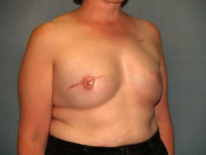 Breast Reconstruction Before & After Patient #2195