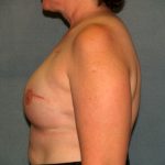 Breast Reconstruction Before & After Patient #2195